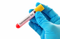 The Most Comprehensive Intolerance Test for 200 Food/Herbs/Antibiotics/Mould/Additives Platinum