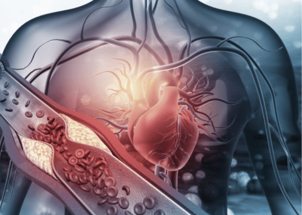 Cardiovascular Profile Test as a risk assessment for Cardiovascular disease with atherosclerotic plaque